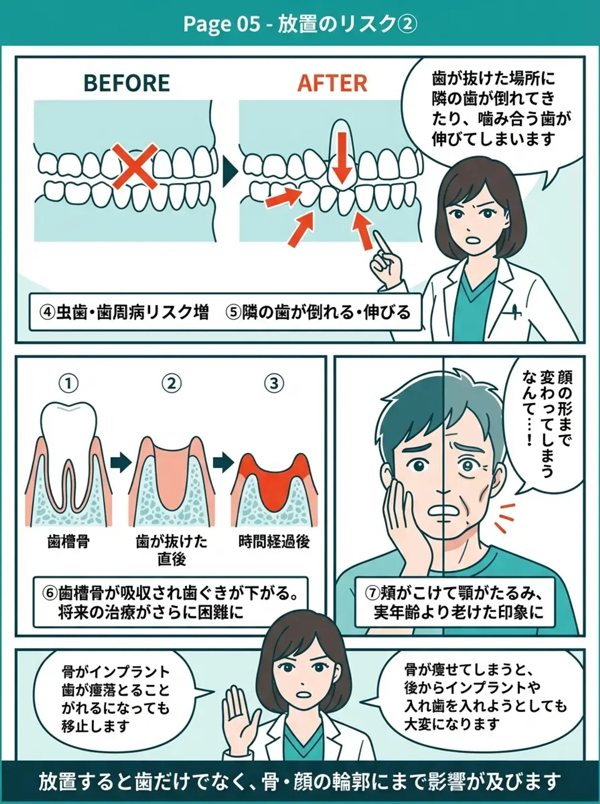 放置のリスク② - 歯列移動のbefore/after図解、歯槽骨の3段階吸収、顔の輪郭変化