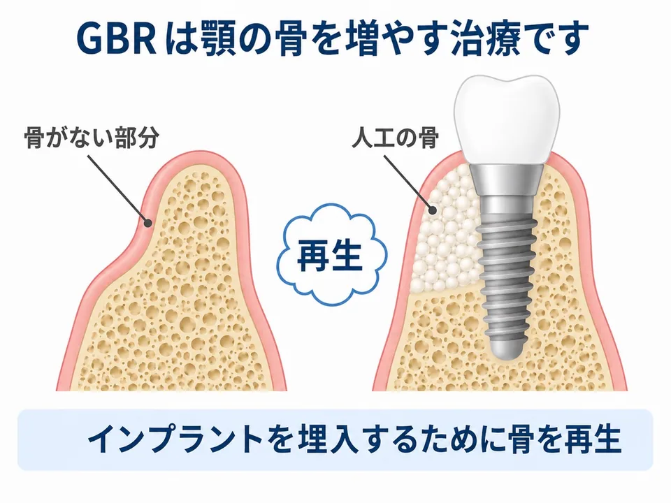 GBRで骨を再生しインプラントを支える土台を作る説明図