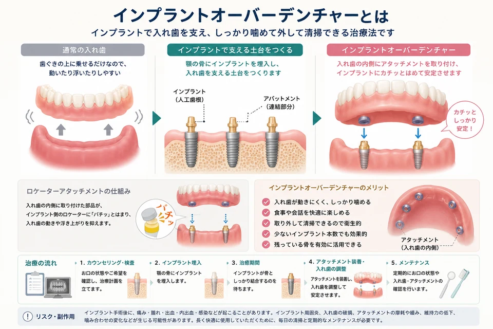 インプラントオーバーデンチャーの仕組みを説明した図