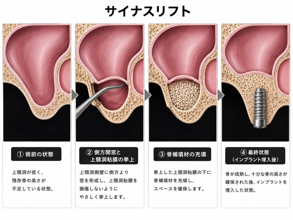 サイナスリフトで上顎洞粘膜を挙上し骨補填材を入れる手順の説明図