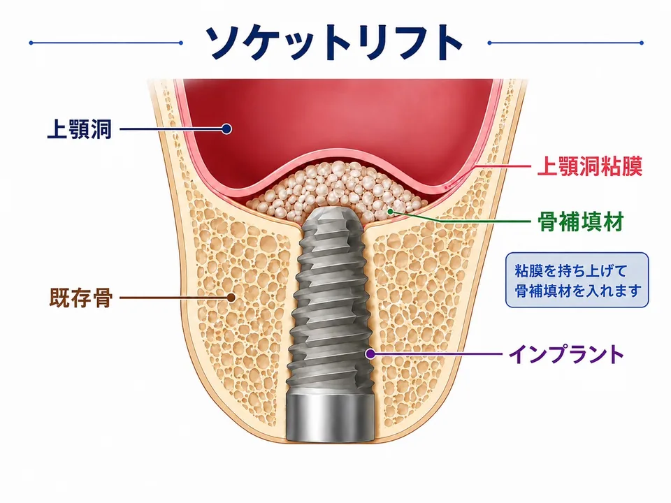 ソケットリフトで上顎洞底を持ち上げ骨補填材を入れる説明図