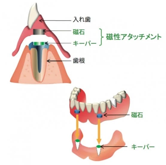 総入れ歯アタッチメント義歯