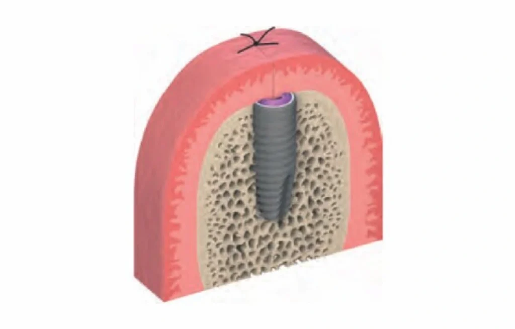 オッセオインテグレーション