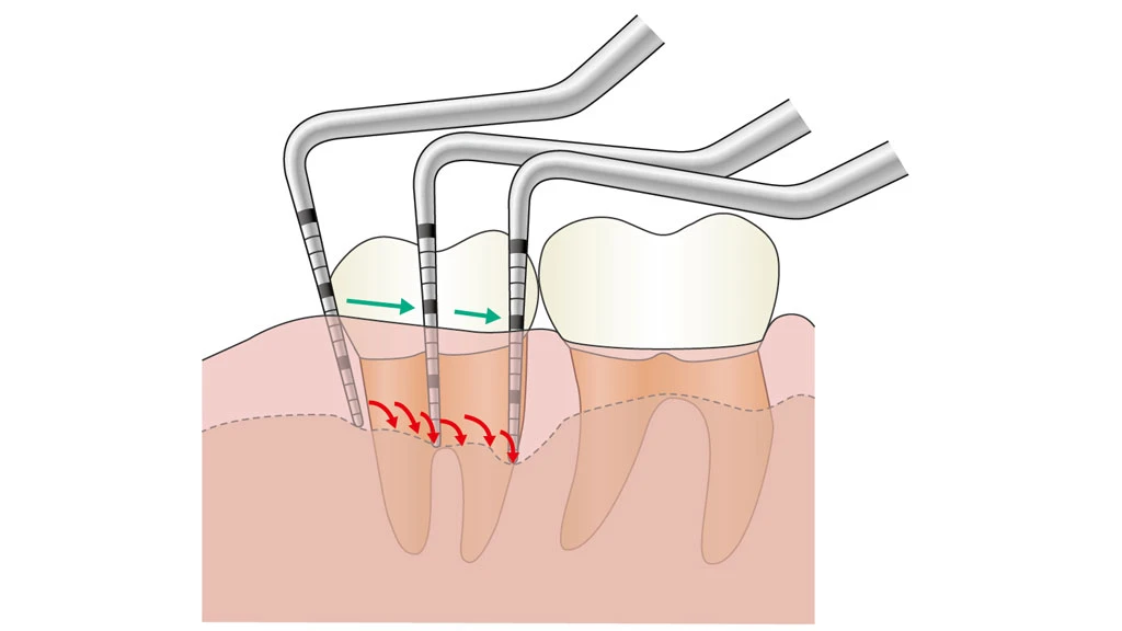 歯周病の再評価検査